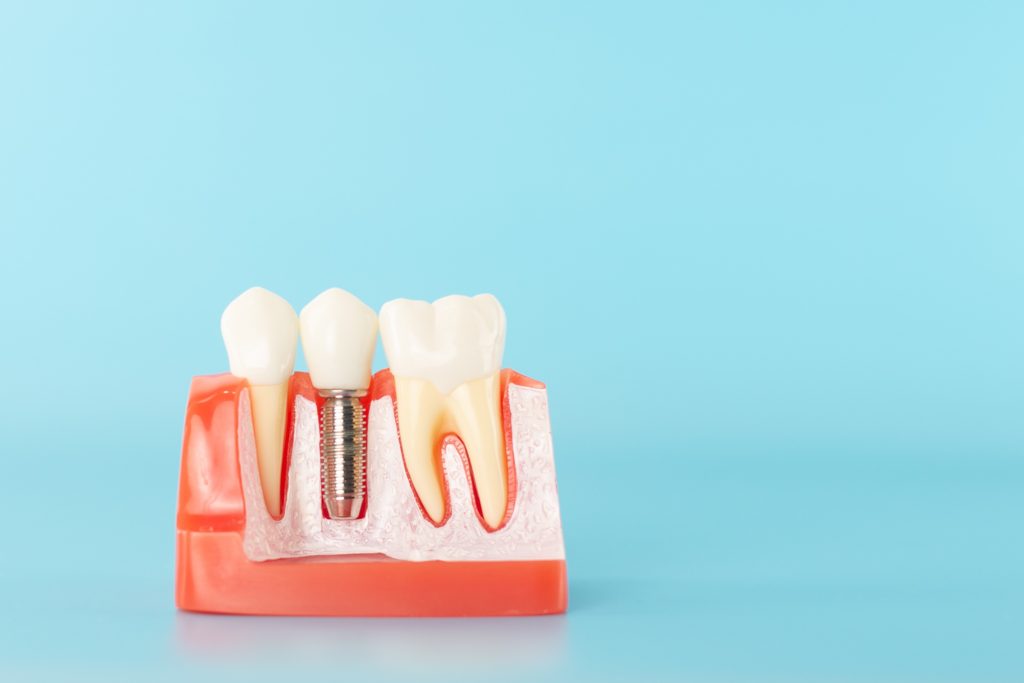 健康な歯とインプラントの違いを示した歯の模型