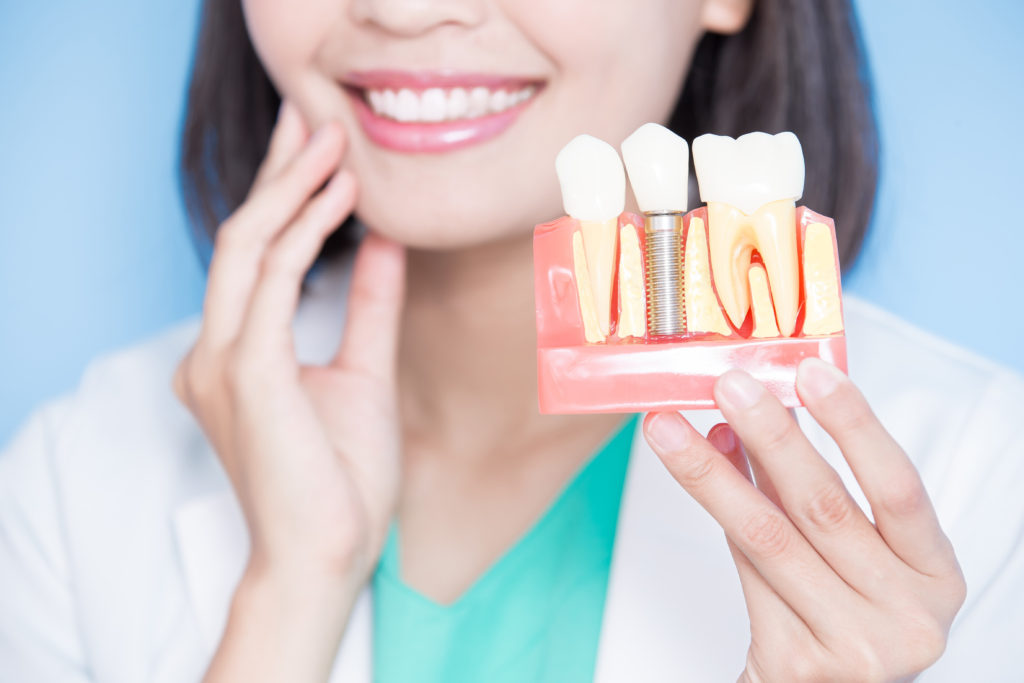 インプラントの模型を持って微笑む女性歯科医師