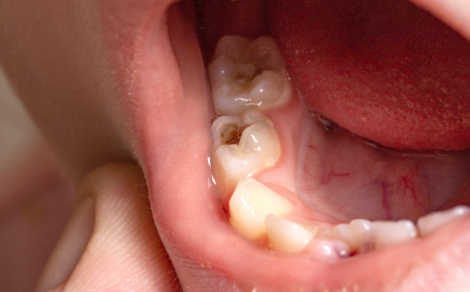 虫歯になった子ども