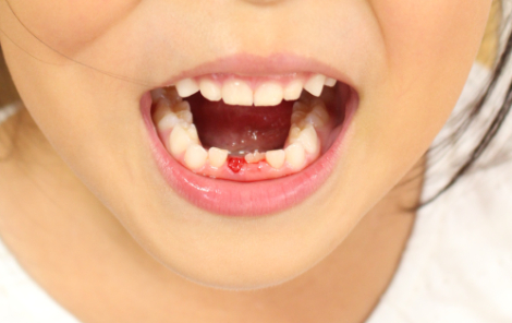 虫歯で乳歯を失った口