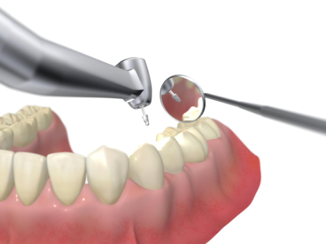 歯を削るイメージ