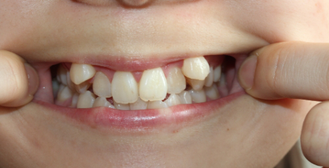 八重歯の生えた子どもの口