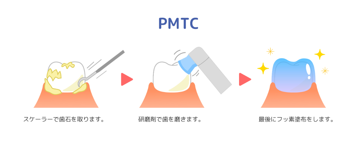 PMTCとはどんな処置？メリット・デメリットや流れ、費用まで徹底解説
