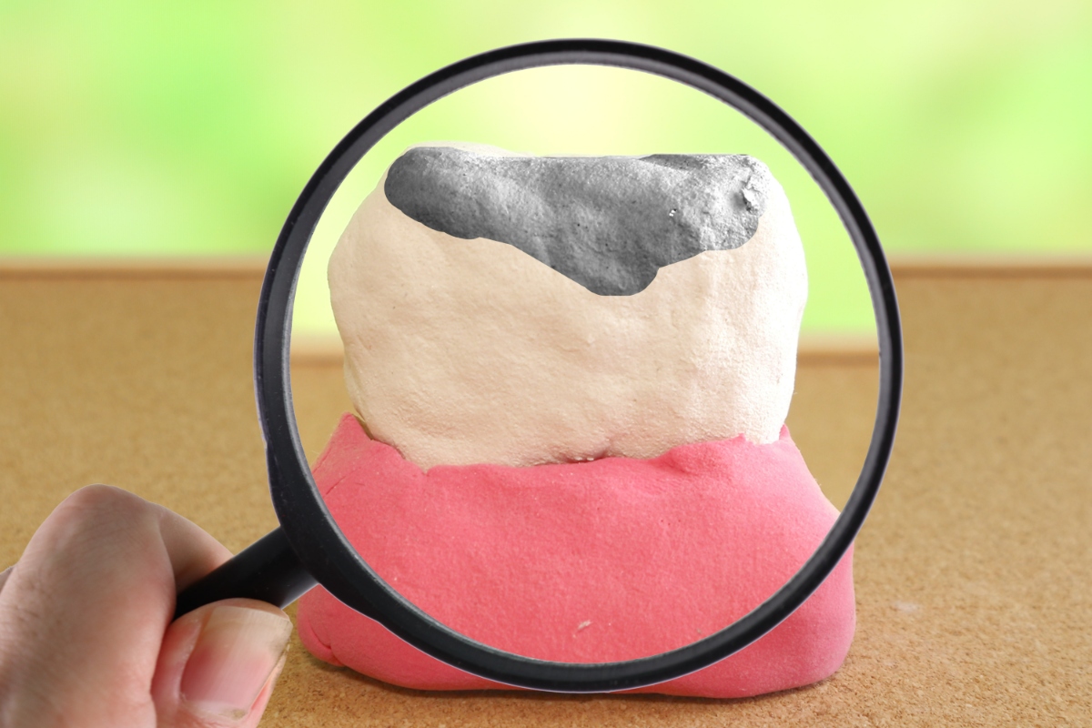 歯の被せ物のイメージ