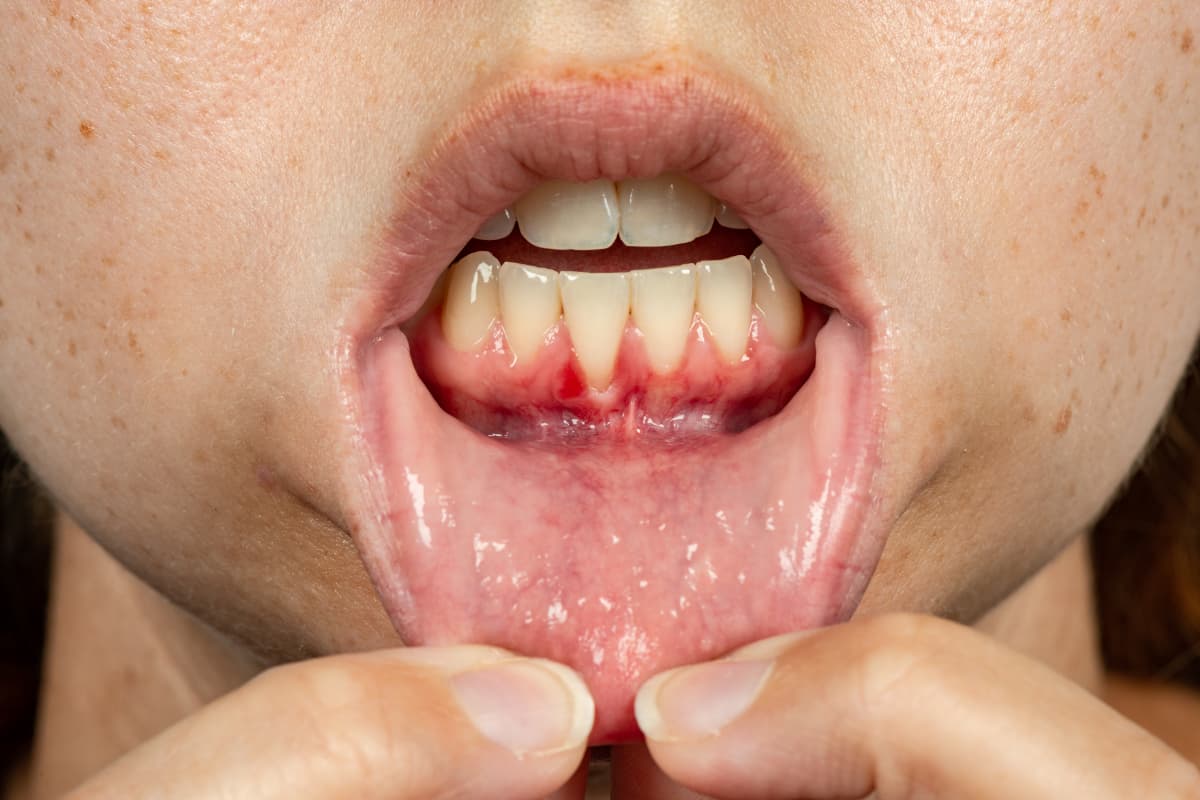 子どもが歯周病になった歯茎を見せる様子